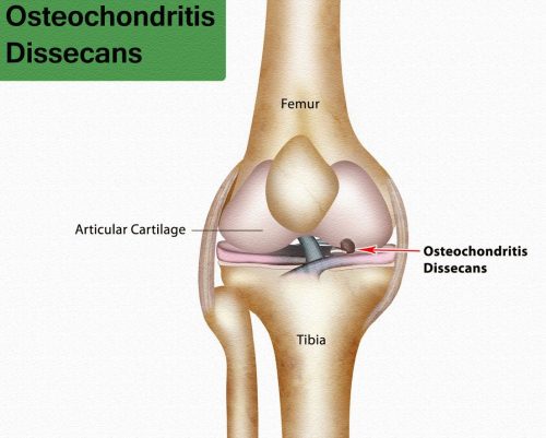 osteochondrosis treatment in humans