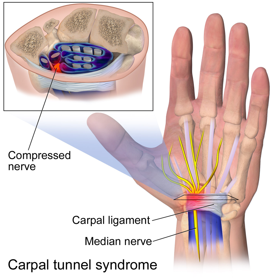 carpal tunnel syndrome prp treatment, kochi, ernakulam, kerala, India