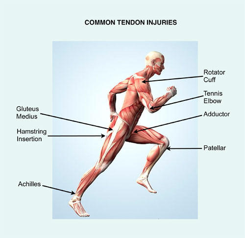 chronic tendon injury prp treatment kochi, ernakulam, kerala, india