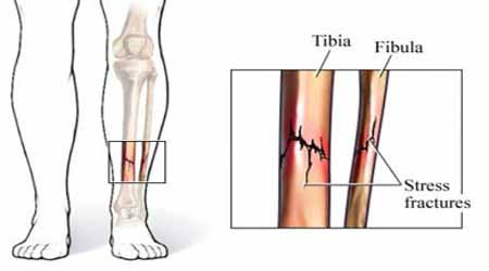 stress fracture prp treatment kochi, ernakulam, kerala, india