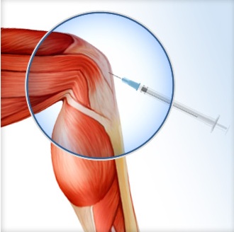 effective orthopedic prp therapy kochi, ernakulam, kerala, india